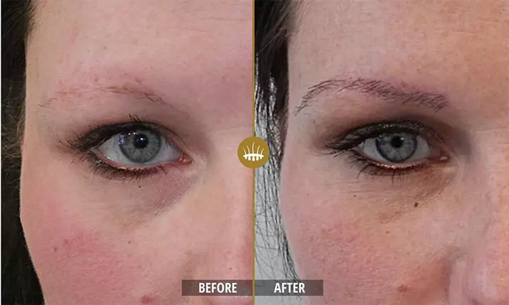 Hair restoration result 16