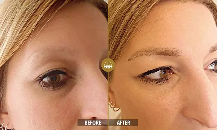 Hair restoration result 17