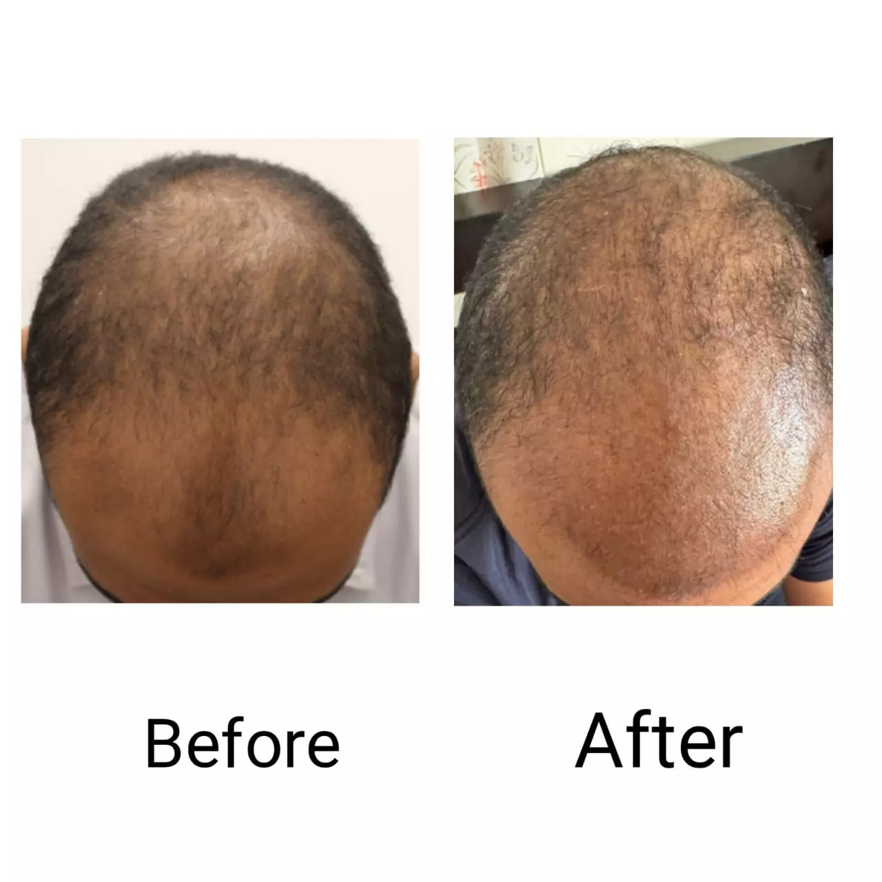 Hair restoration result 2