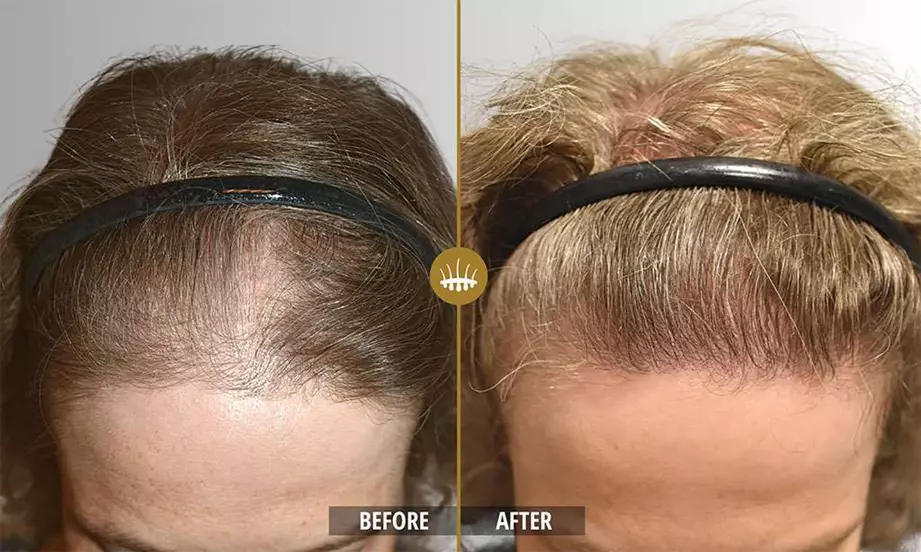 Hair restoration result 6