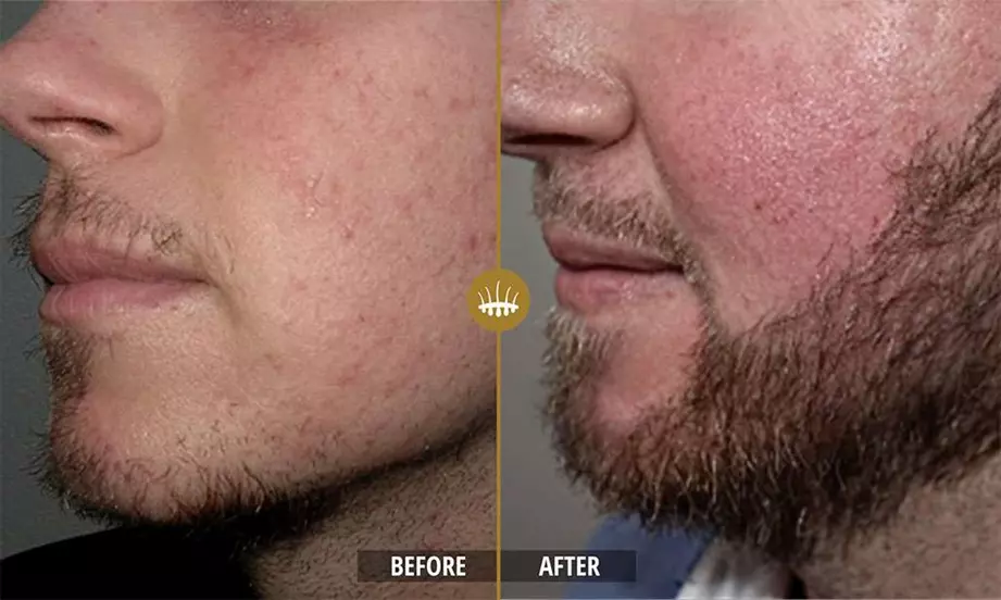 Hair restoration result 9